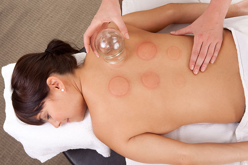 Cupping Therapy Long Island NY