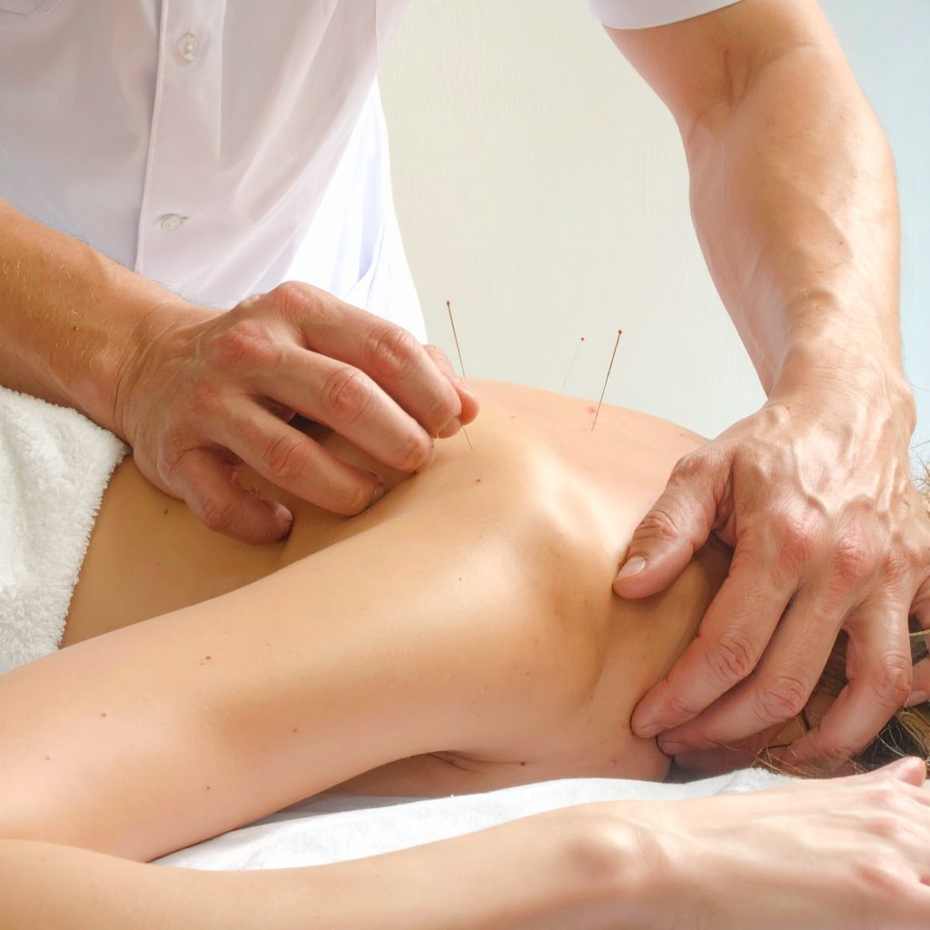 acupuncture Palm Harbor Florida